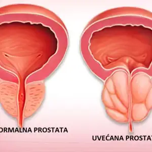 Prostata