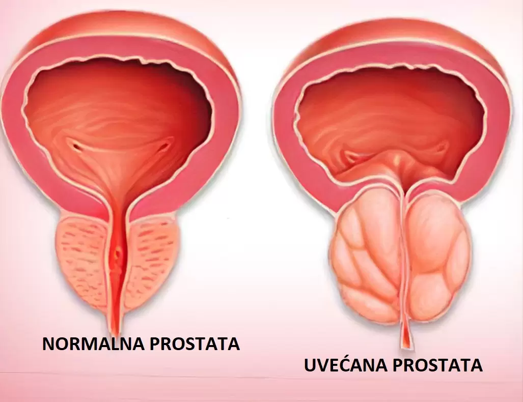 prostata