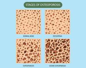 Osteoporoza